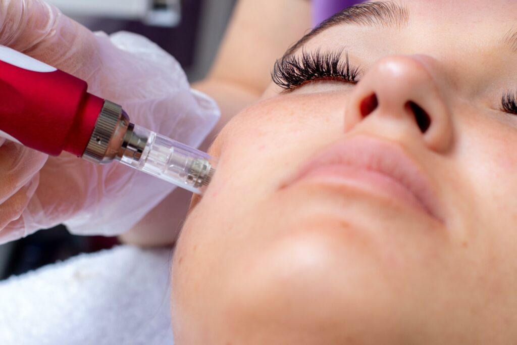 What To Expect From Microneedling With Skinpen in Tulsa, OK | Soul Aesthetics in Tulsa, OK