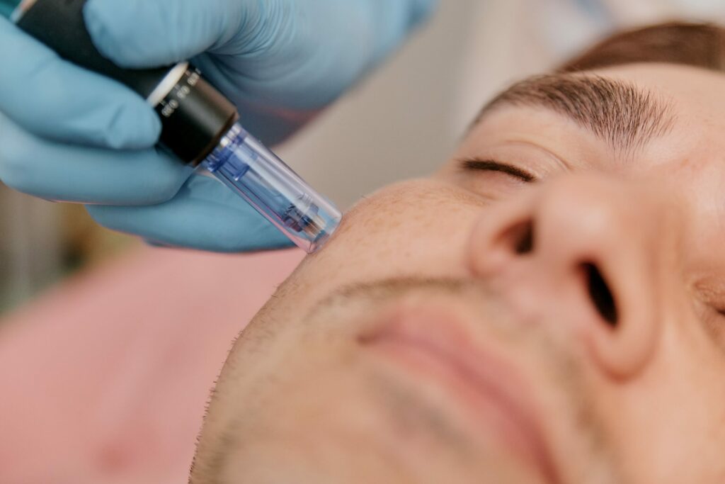Young mens Face with closed eyes - Microneedling for Acne scars woman holding Dermaroller t in cosmetic clinic | Soul Aesthetics in Tulsa, OK