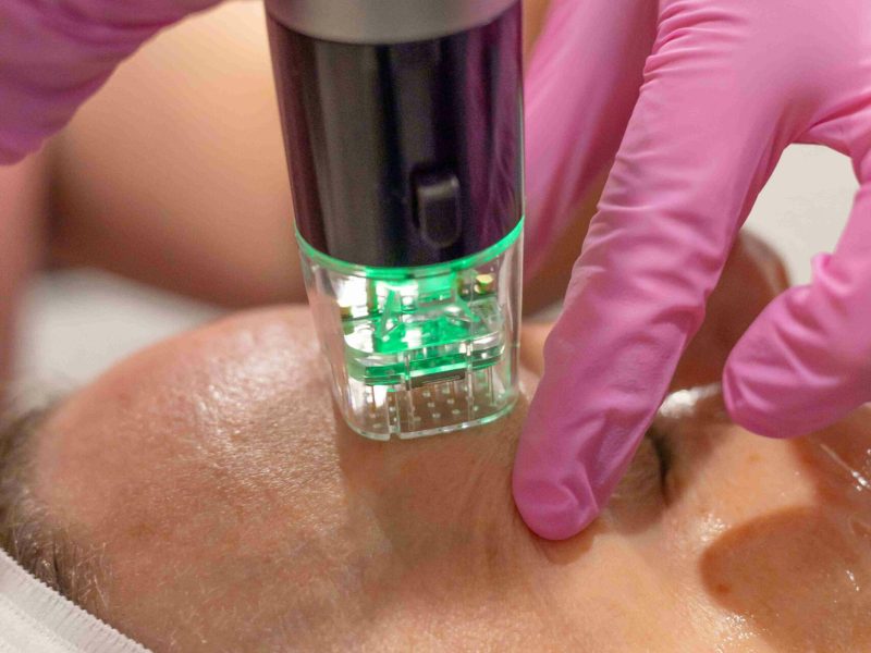 Mid-Aged Women Receive Microneedling Treatment at Soul Aesthetics in Tulsa, OK