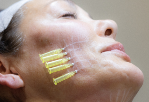 during a pdo thread lift procedure, a woman with yellow tubes waiting for the treatment