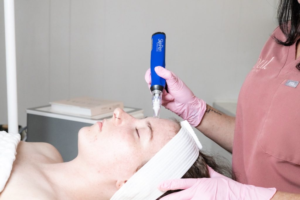 microneedling performed on woman for best skin results