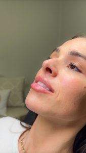 woman with soul sprinkle treatment to tighten sagging skin under your chin