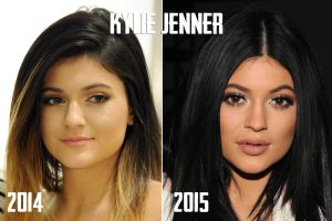 Kylie Jenner lip filler