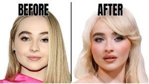 Sabrina Carpenter lip filler