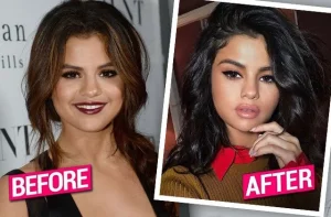 selena gomez lip filler