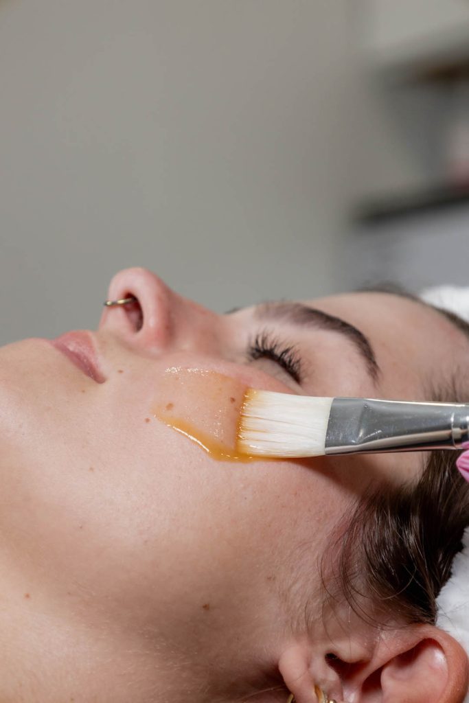 woman receiving a chemical peel for smoothing of skin on face