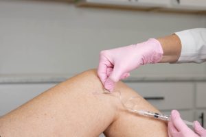 how to get rid of spider veins