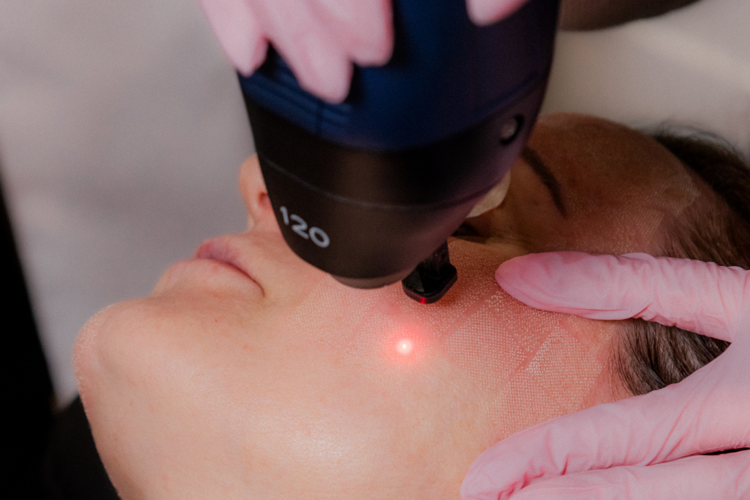 CO2 Laser Treatment on client at soul aesthetics