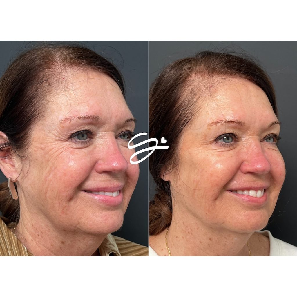 Alt text: "Before and after Soul Sprinkle facial balancing treatment at Soul Aesthetics in Tulsa, showing natural volume restoration, smoother skin texture, and improved facial harmony with dermal filler
