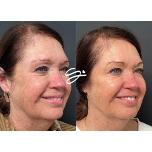 Alt text: "Before and after Soul Sprinkle facial balancing treatment at Soul Aesthetics in Tulsa, showing natural volume restoration, smoother skin texture, and improved facial harmony with dermal filler