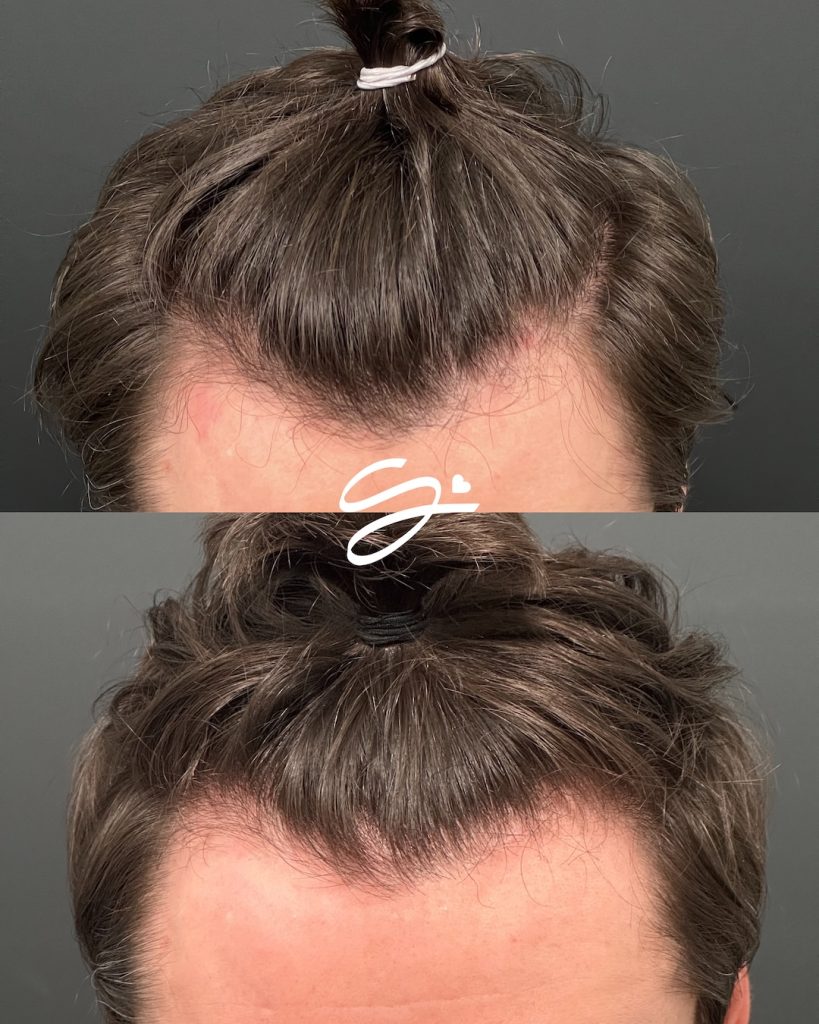 Soul-hair restoration